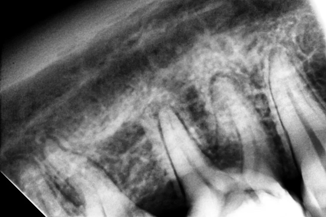 Woodpecker i-Sensor Digital Intra-Oral X-Ray Sensor - H1, H1.5, H2