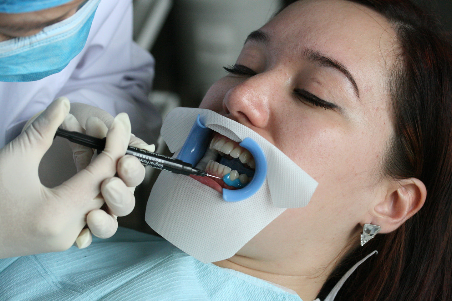 BEYOND BlueSeal Gingival Protection - In Office