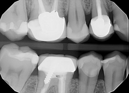 Ecotron DT-703 Handheld Dental X-Ray | 0.3 mm Focal Spot | 70 kV | Free Loaner Program