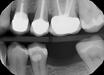 Ecotron DT-703 Handheld Dental X-Ray | 0.3 mm Focal Spot | 70 kV | Free Loaner Program