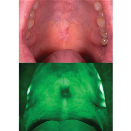 AdDent Bio/Screen Oral Cancer Exam Light - Complete Kit