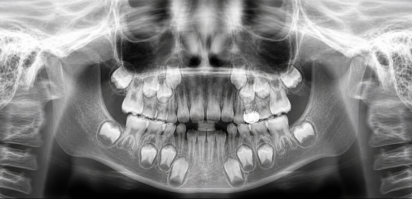 Genoray Papaya 3D Lite | CBCT + Pan 16x8 FOV
