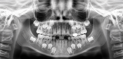 Genoray Papaya 3D Lite | CBCT + Pan 16x8 FOV