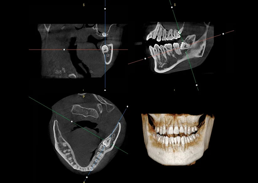 Genoray Papaya 3D Lite | CBCT + Pan 16x8 FOV