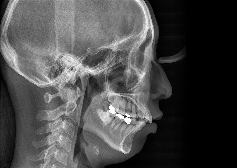 Genoray Papaya 3D Lite Plus | CBCT + Pan + Ceph 16x8 FOV
