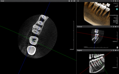 Genoray Papaya 3D Lite | CBCT + Pan 16x8 FOV