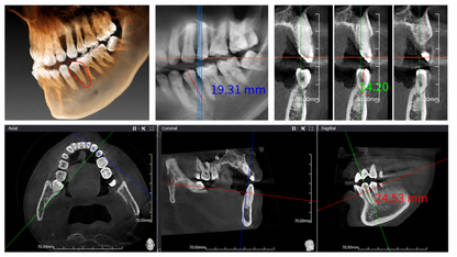 Genoray Papaya 3D Lite | CBCT + Pan 16x8 FOV