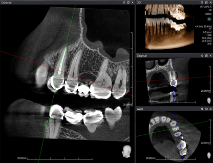 Genoray Papaya 3D Lite | CBCT + Pan 16x8 FOV