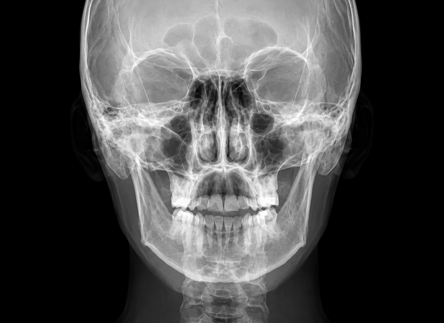 Genoray Papaya 3D Lite Plus | CBCT + Pan + Ceph 16x8 FOV