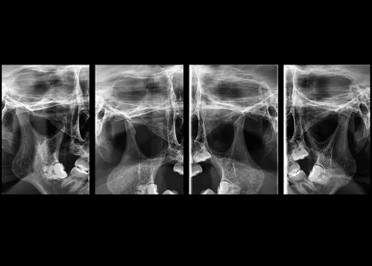 Genoray Papaya 3D Premium Plus | CBCT + Pan + Ceph + 3D Model Scanning 16x14 FOV