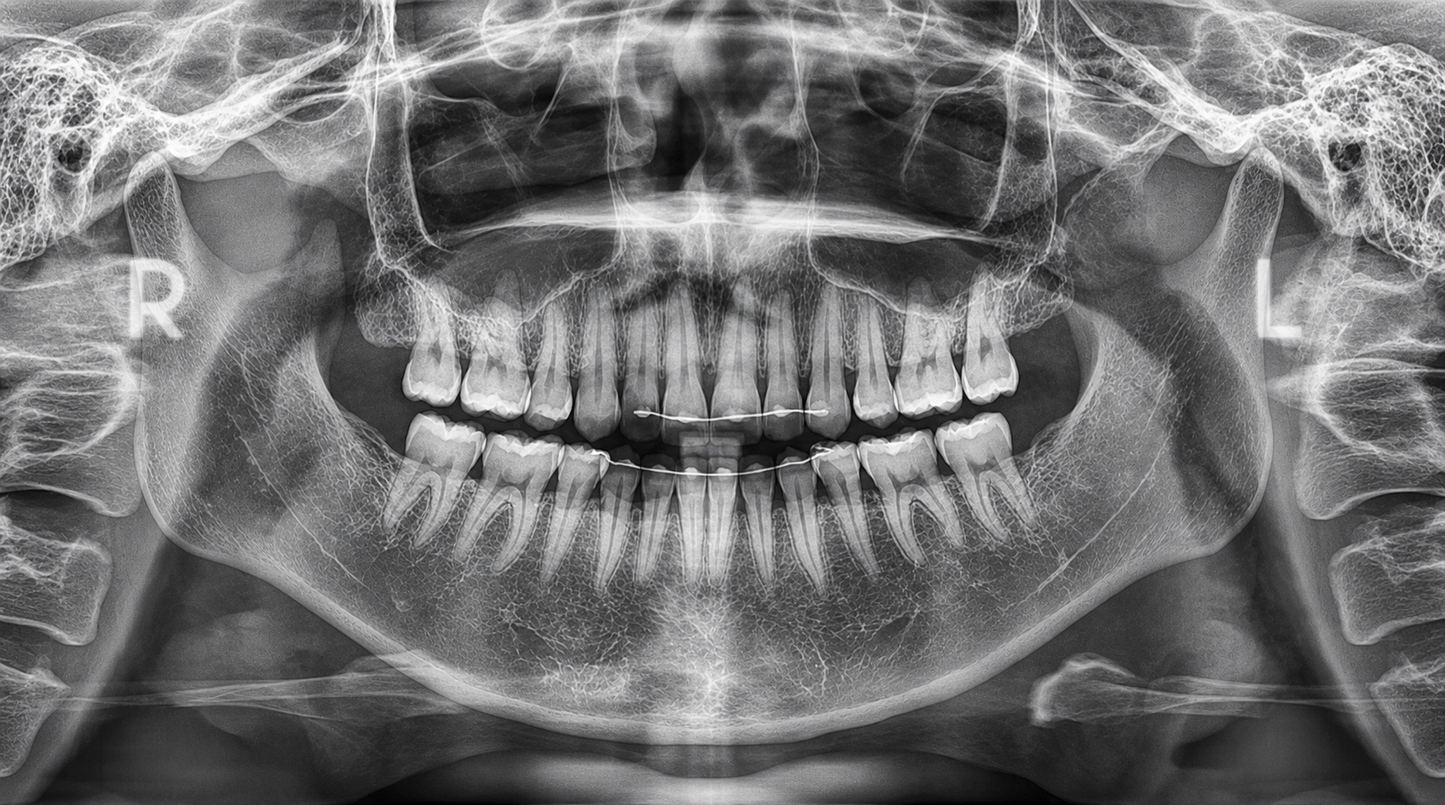 Genoray Papaya 3D Lite | CBCT + Pan 16x8 FOV