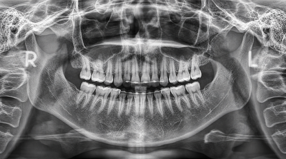 Genoray Papaya 3D Lite | CBCT + Pan 16x8 FOV
