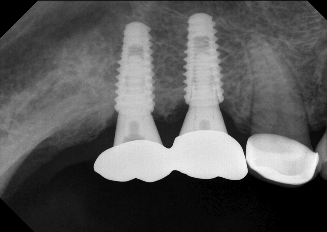 Genoray GIX-1 Digital Intraoral X-Ray Sensor | Size 1 & Size 2 CMOS